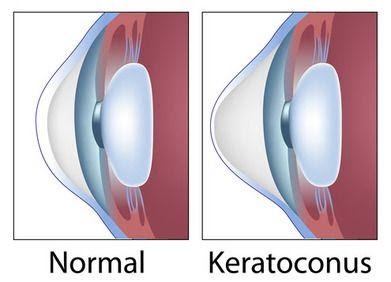 How to determine if LASIK Eye Surgery is Suitable for You