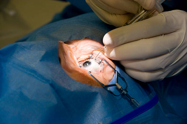 1. Cataracts surgery changes the lens