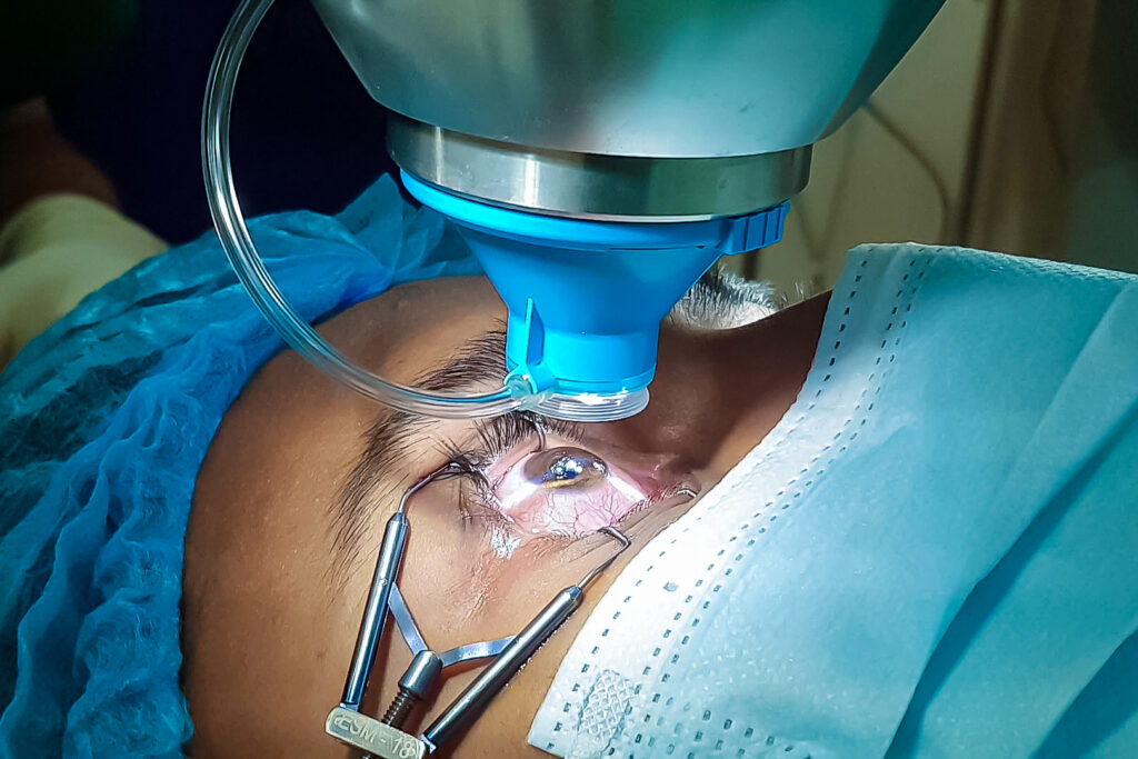 Lasik Surgery