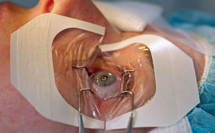 LASIK Eye Surgery Procedure